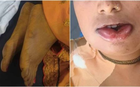 जहरीली हल्दी बनी जानलेवा! शादी से पहले उबटन लगाते ही दुल्हन की मौत