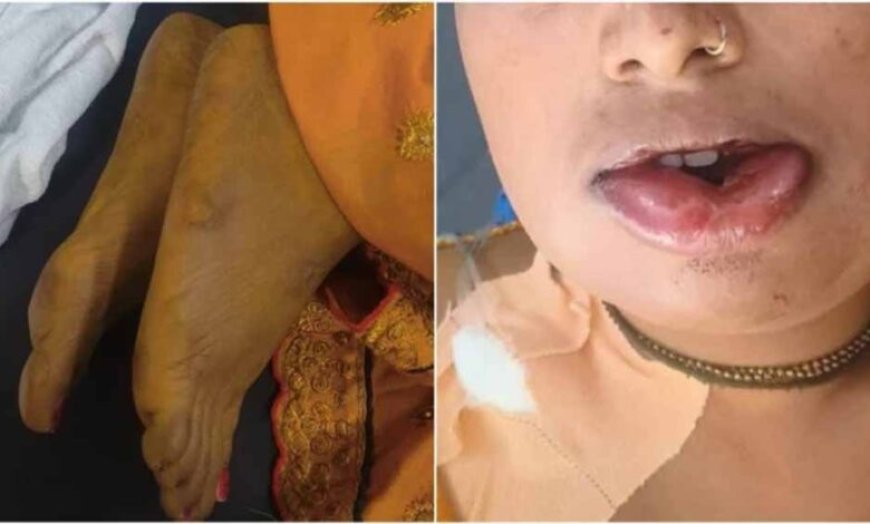 जहरीली हल्दी बनी जानलेवा! शादी से पहले उबटन लगाते ही दुल्हन की मौत